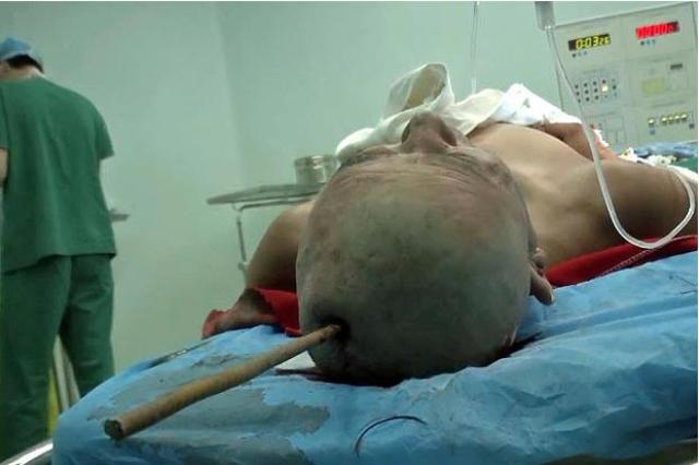 Barra de metal le atravesó el cráneo, pero está fuera de peligro (Foto)