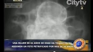 Descubren un feto petrificado en una anciana de 84 años
