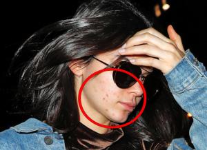 ¡Ellas tampoco son perfectas! Un severo brote de acné ataca el rostro de Kendall Jenner