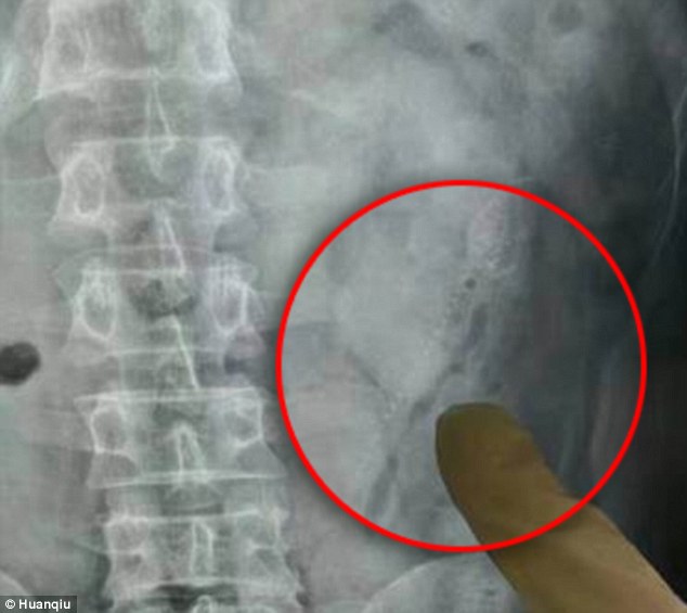 ¡QUEJESTO! Chino ocioso introdujo dos peces por su retaguardia y uno le atravesó el intestino (FOTOS)