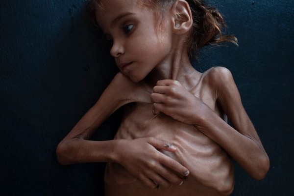 Murió Amal Hussain, la niña símbolo de la hambruna en Yemen
