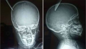 Un niño le clavó un cuchillo en el cráneo a su amiguito de cinco años