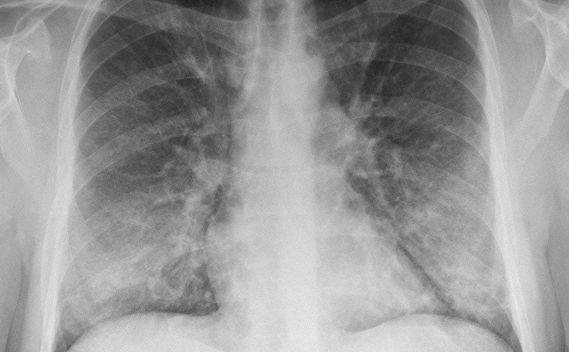 Descubren una nueva grave enfermedad pulmonar vinculada al vaping