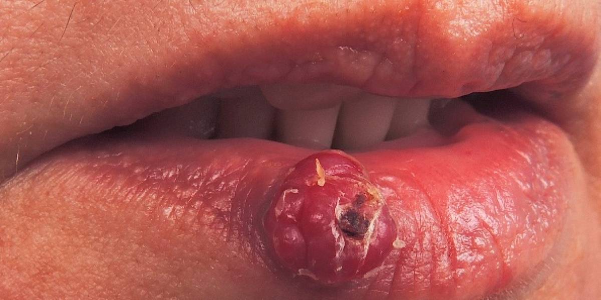 La extraña enfermedad de una mujer a la que le crecen vellos en las encías (Fotos)