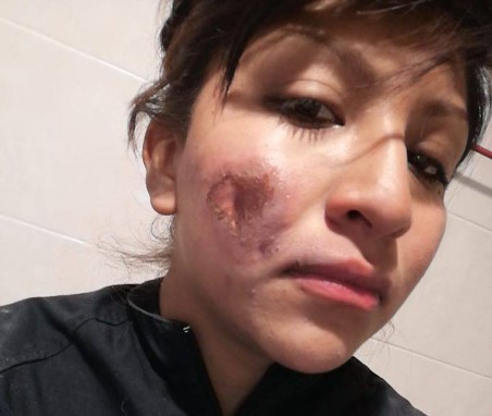 “Feministas” quemaron el rostro de mujer policía: No he matado ni violado a nadie (FOTO)