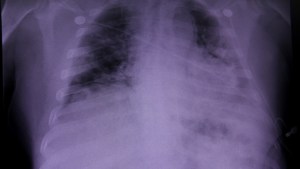 Identifican daños pulmonares que podrían estar asociados a un síndrome conocido como “Covid largo”