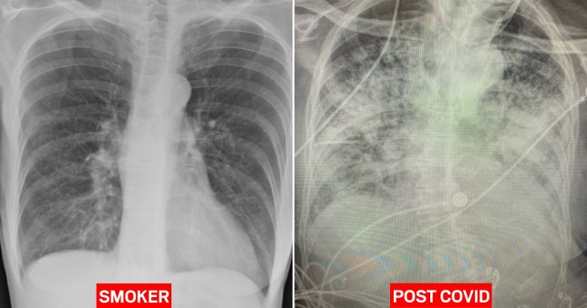 Radiografía revela que los pulmones de infectados con Covid-19 se ven peor que los de un fumador