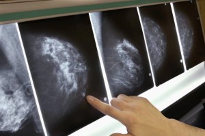 Nuevo fármaco multiplica la supervivencia en mujeres con cáncer de mama metastásico