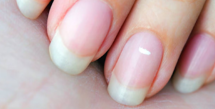 ¿Son peligrosas las líneas blancas que aparecen en las uñas?