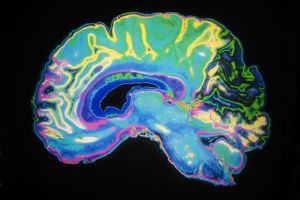 Científicos desarrollan investigaciones para tratar el Alzheimer
