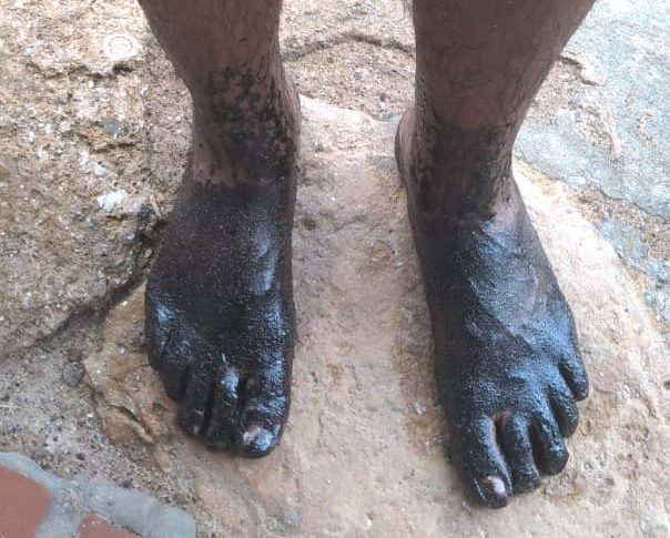 Otro derrame de crudo en playas de Paraguaná: Los turistas huyen al verse manchados por petróleo