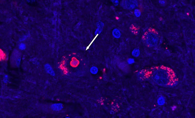 Descubren la causa de una rara enfermedad genética, hallazgo clave para futuras terapias